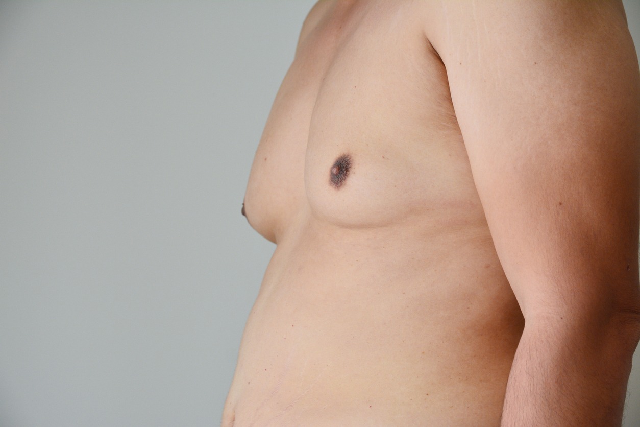 Male Breast Reduction Gynecomastia PHX Plastic Surgery